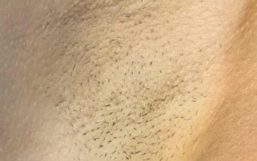 Épilation laser des aisselles chez DEPILOR à Vénissieux, avant les séances.