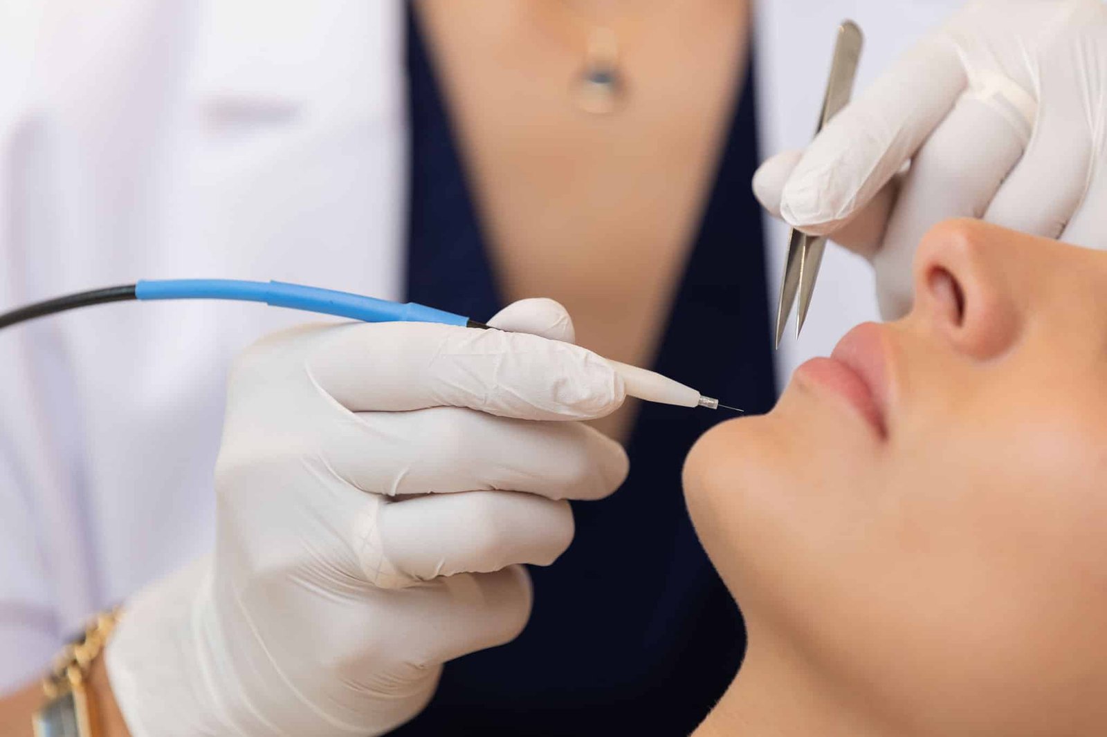 Électrolyse et SOPK : traitement des poils hormonaux